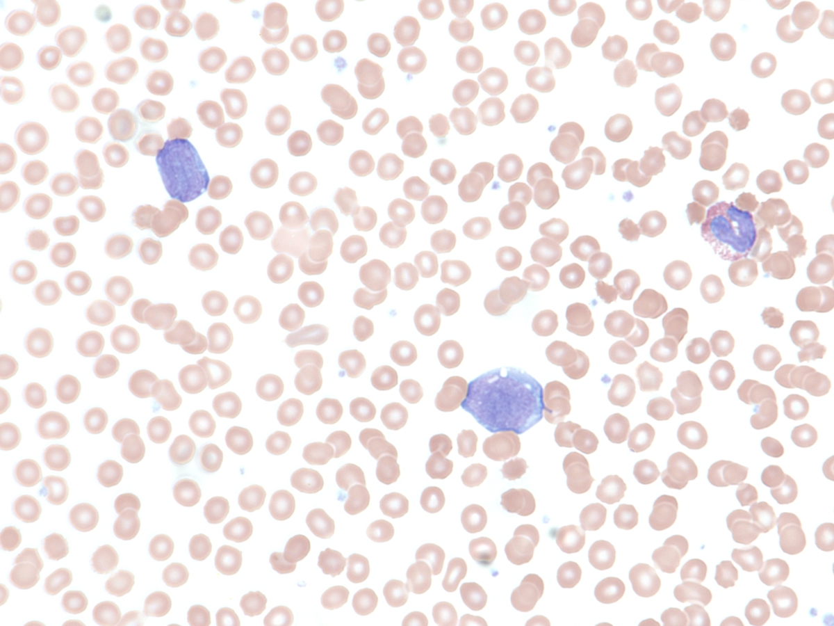 peripheral blood with blasts, 60x, 1 month after gastric biopsy